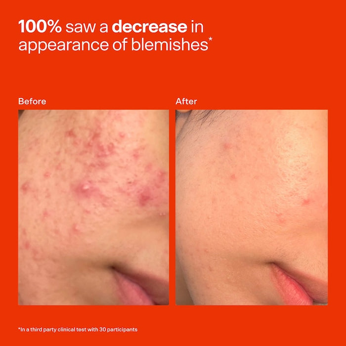 SOS Daily Hypochlorous Acid Spray for Breakouts & Redness (2 size)